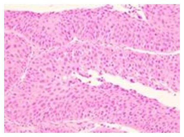 Patient-derived bladder cancer tissue images